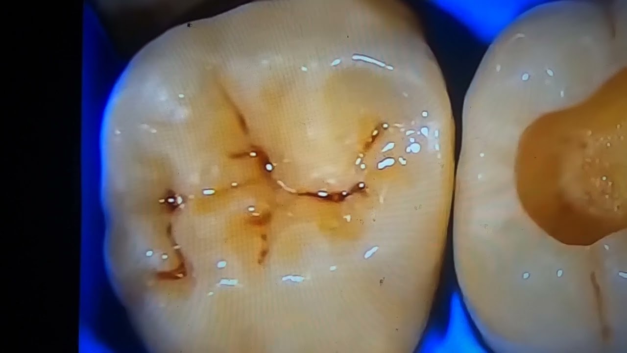 tnusrb medical test for teeth