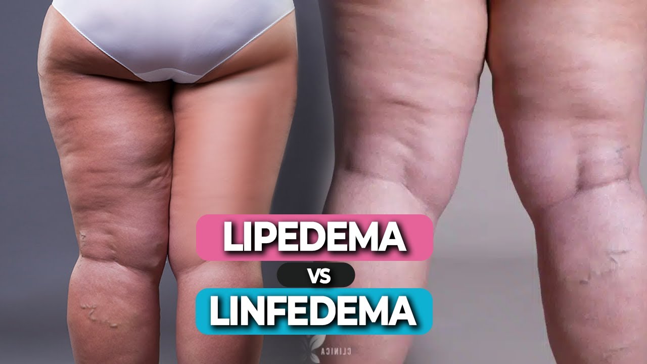 Diferença entre Lipedema e Linfedema: O que você precisa saber! - YouTube