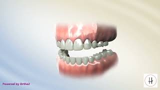 Ectopic Maxillary First Molar Eruption | High Line Orthodontics | New York, NY