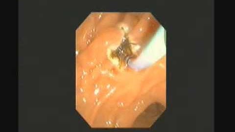 ERCP - Sphincterotomy and Stone Extraction - STEFANOS DOKAS - The ERCP Channel