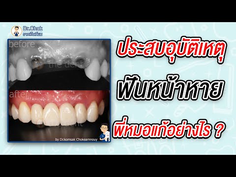 ประสบอุบัติเหตุมา ฟันหน้าหาย พี่หมอโชคแก้อย่างไร ?!! | Talk Case กับหมอโชค