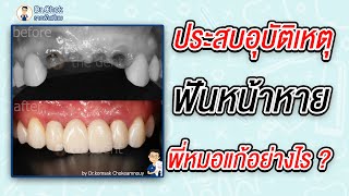 ประสบอุบัติเหตุมา ฟันหน้าหาย พี่หมอโชคแก้อย่างไร ?!! | Talk Case กับหมอโชค
