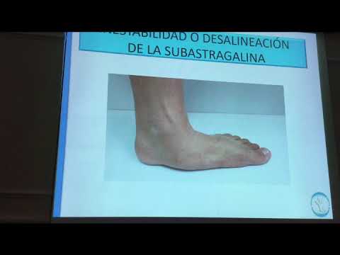 Video: ¿Qué es una fusión de la articulación subastragalina?