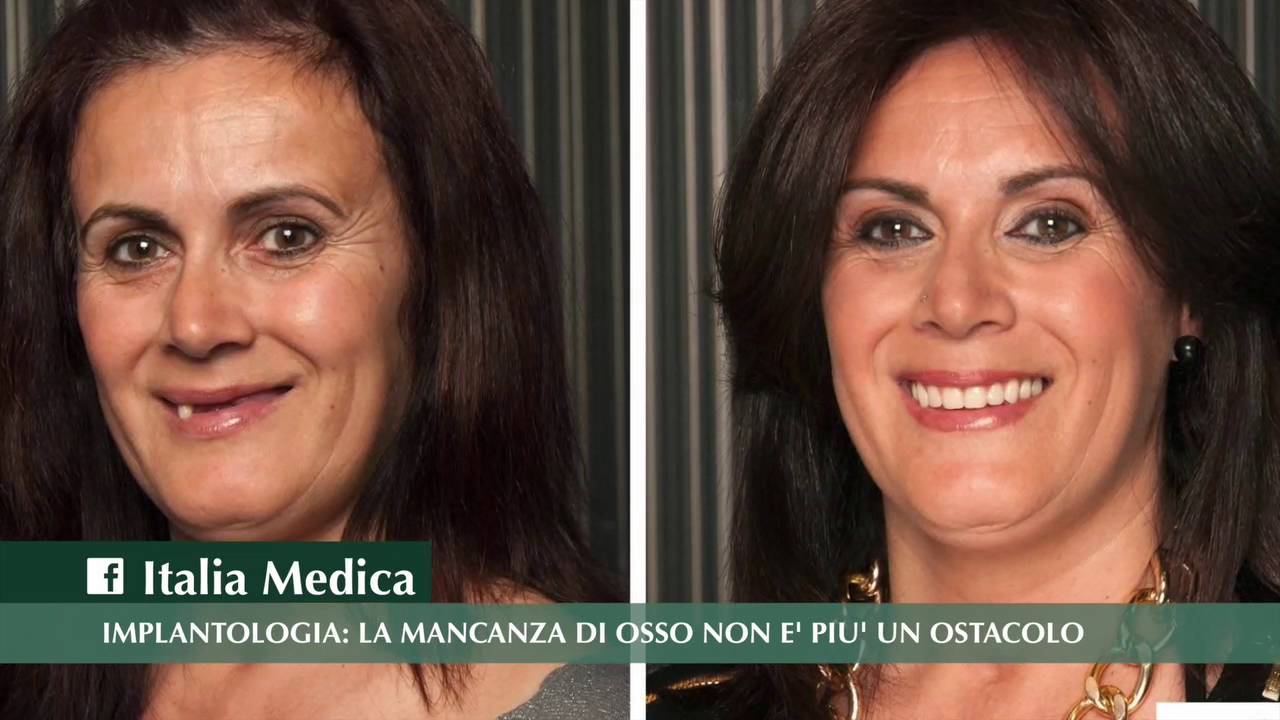Implantologia: la mancanza di osso non è più un ostacolo