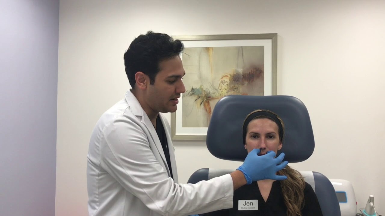 Botox treatment for gummy smile by Dr. Shaun Patel