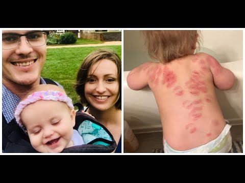 mom-finds-25-bite-marks-on-her-15-month-old-daughter-after-picking-her-up-from-daycare