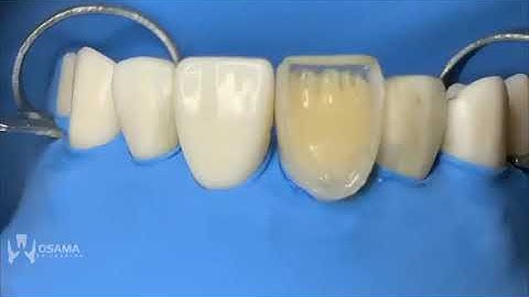 Direct composite veneer with the help of unica matrix credit to dr osama