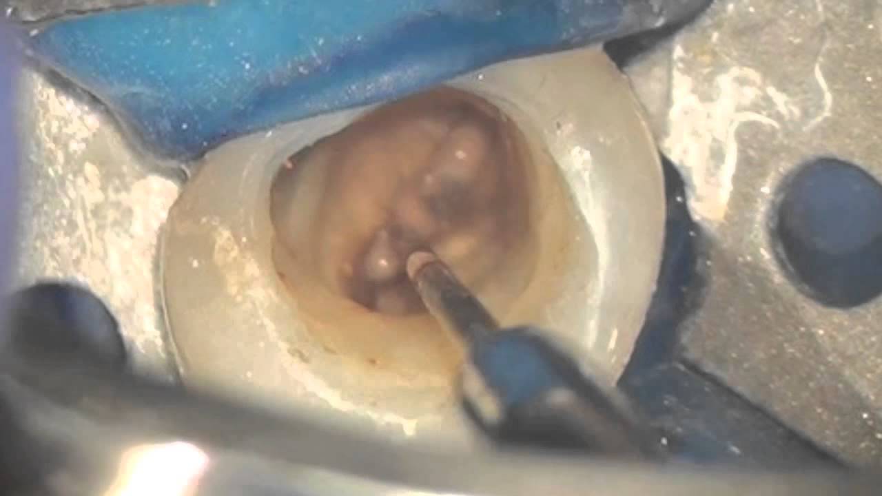 Silver endo post YouTube