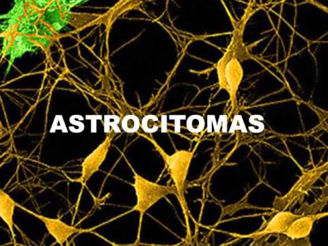 Vídeo: Tumor Cerebral (astrocitoma) En Gats