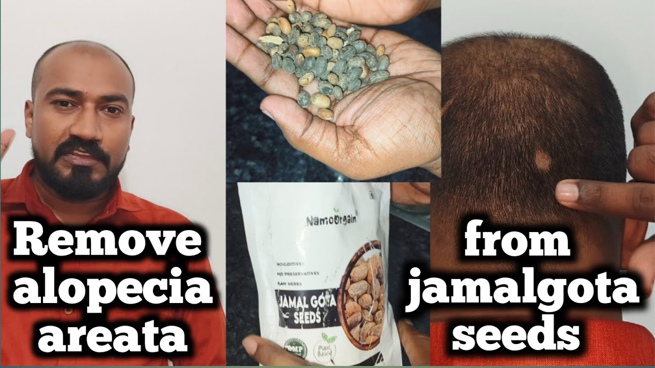 Remove alopecia areata from jamalgota seeds 