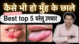 मुंह के छालों (Mouth Ulcers) का घरेलू उपाय | mouth ulcer home remedy