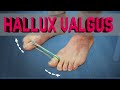 Hallux valgus. Как избавиться от косточки на большом пальце ноги без операций!