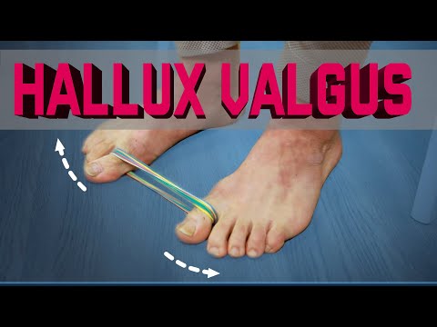 Video: Hallux Valgus Al Piciorului și Degetelor - Tratament