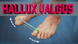 Hallux valgus. Как избавиться от косточки на большом пальце ноги без операций!