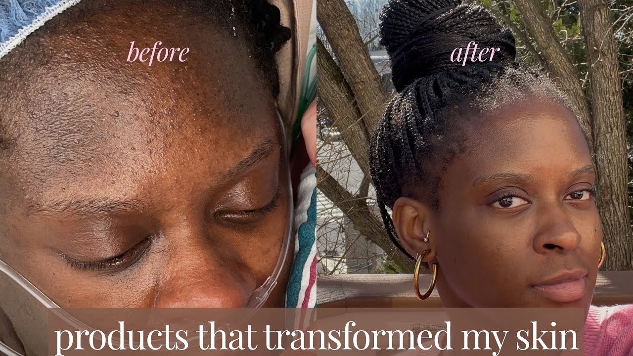 how I got rid of my acne + hyperpigmentation | HUE supra fade, products ...