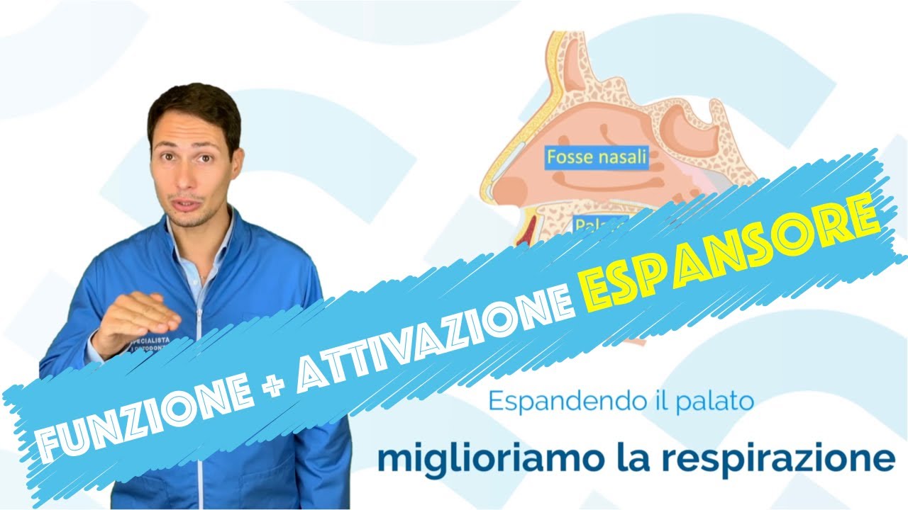 Espansore del palato (cosa è, funzioni e attivazione) - detto anche REP o diastasatore