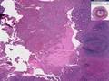 Histopathology Acute Appendicitis