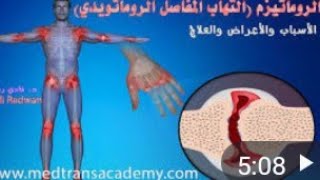 اعراض روماتزم العظام فى الركبتين ???