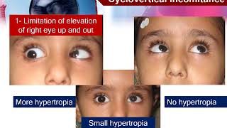 1-3 Motor evaluation of strabismus: Comitant and non-comitant strabismus