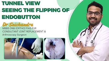 Tunnel View.. Seeing The Flipping Of Endobutton..Dr Sai Chandra .. Arthroscopy Surgeon In Hyderabad