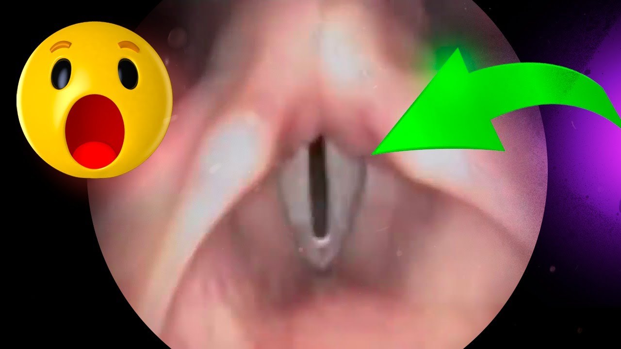 nodulos nas cordas vocais cirurgia