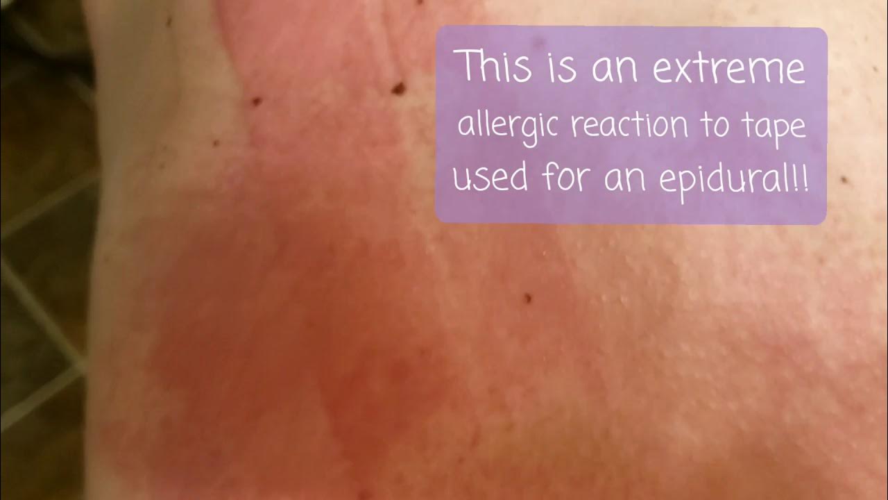 Worst allergic reaction to tape, ever! YouTube