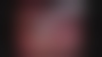 Robotic Partial Nephrectomy