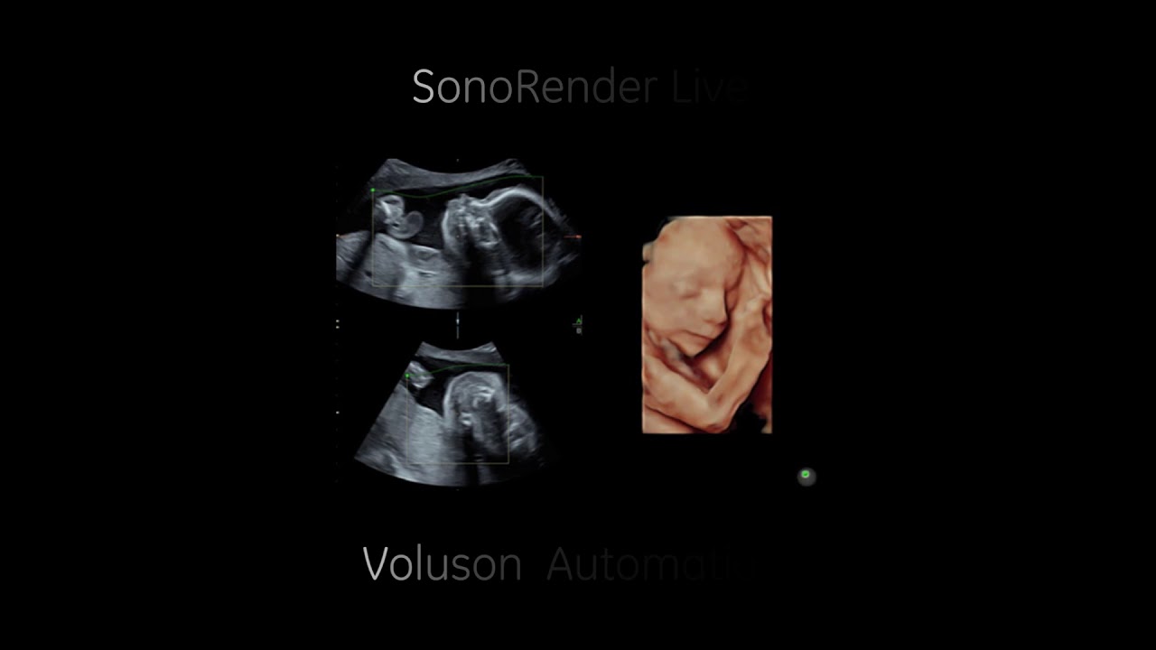 Extraordinary productivity for busy practice with Voluson S8 Scanner