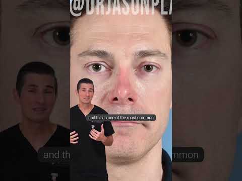 Video thumbnail: Recent revision rhinoplasty before and after · Jason Roostaeian