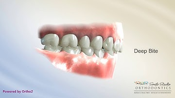 Curve of Spee Correction - TAD, Lower