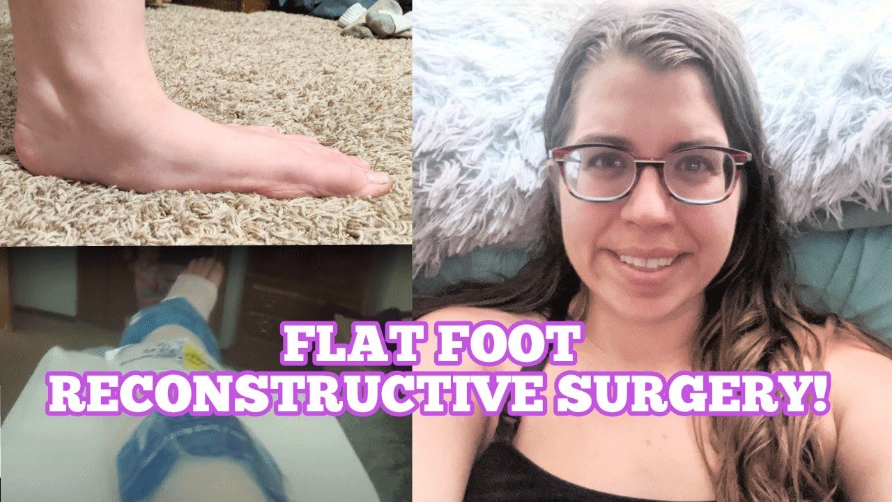 FLAT FOOT RECONSTRUCTIVE SURGERY SERIES 1 YouTube