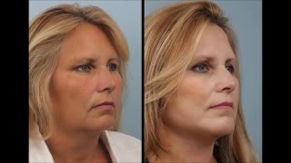 What is a face lift? with Dr. Edwin Williams