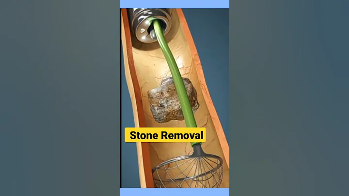 3D Key Hole Stone Removal | #kidneystone #kidneystonetreatment #3danimation #shorts #ytshorts #stone - DayDayNews