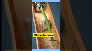 3D Key Hole Stone Removal | #kidneystone #kidneystonetreatment #3danimation #shorts #ytshorts #stone screenshot 3