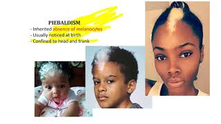 Pigmentation Disorder - Vitiligo, Monian Spots & Piebaldism
