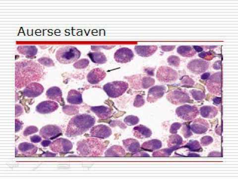 Video: Beenmergfalen Kan Worden Veroorzaakt Door Chromosoomafwijkingen Die Effecten Hebben Op Het RUNX1T1-gen