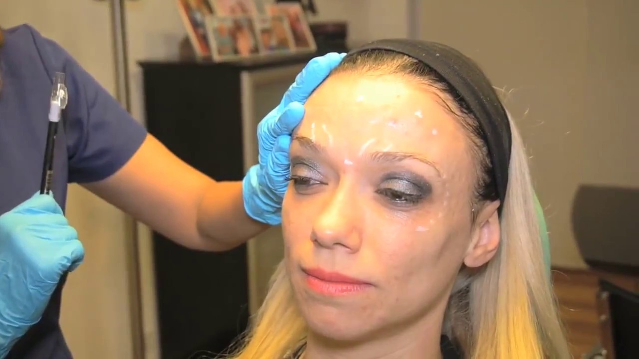 Aplicación Toxina Botulínica