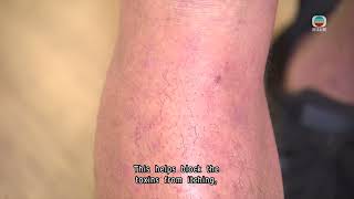 HK developed skin-cream may help eczema sufferers | TVB News | 2026/02/12