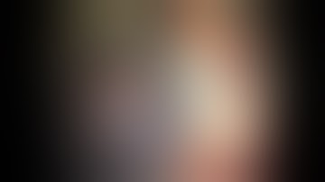 ASCRS 2013 Lessons Learned Complications of Glued IOL