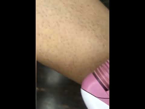 Hair removal whit epilator