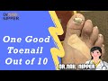 One Good Toenail Out of 10, Spanish Diabetic Talk