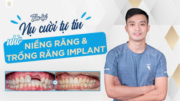Tìm Lại Nụ Cười Tự Tin Sau 1 Năm Nhờ Niềng Răng Và Trồng Răng Implant | Bác sĩ Trung Long Biên