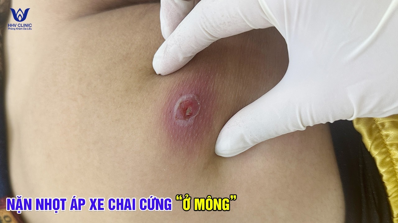 Ổ Mụn Áp Xe Sưng Đỏ Đau Nhức Ở Mông - Xử Lý Lấy Sạch Mủ Viêm.