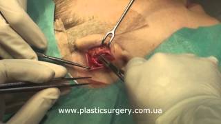 Отопластика, пластика ушных раковин | Otoplasty, Ear Reshaping | Live Surgery(http://novetilo.com.ua/operatsii/operatsii-na-litse/otoplastika-plastika-ushnykh-rakovin.html http://www.plasticsurgery.com.ua Демонстрация ключевых ..., 2012-12-19T18:26:08.000Z)