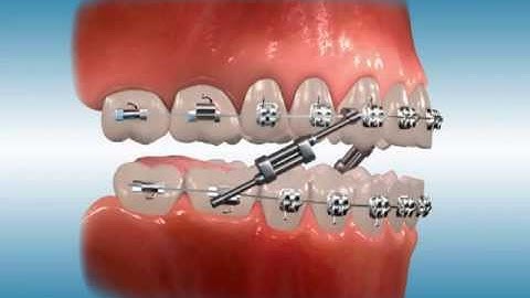Twin Force® Bite Corrector for Class III Correction