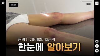 허벅지 지방흡입 사후관리 비포애프터 ㅣ  바본관리 리뷰