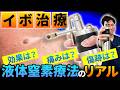 【イボ治療を皮膚科医が解説】液体窒素療法ってどんな治療？費用・痛み・回数・副作用まで！