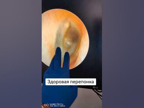 Здоровая барабанная перепонка. - YouTube