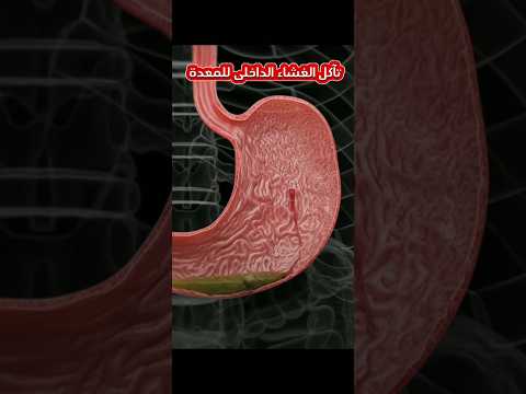 قرحة المعدة بالغشاء الداخلى قرحة المعدة