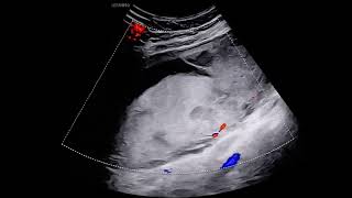 Micro-Vascular Imaging in Placental Infarction – Video S1 [440522]